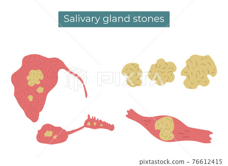 Vector flat illustration of stones in the parotid, submandibular and sublingual salivary glands and duct. Vector flat illustration of stones in the parotid, submandibular and sublingual salivary glands and duct. 76612415