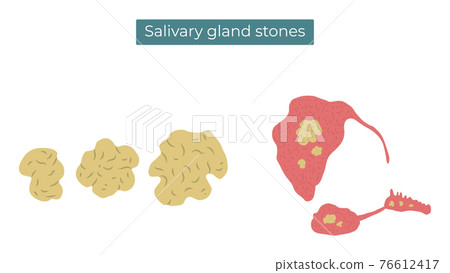 Vector flat illustration of stones in the parotid, submandibular and sublingual salivary glands. Vector flat illustration of stones in the parotid, submandibular and sublingual salivary glands. 76612417