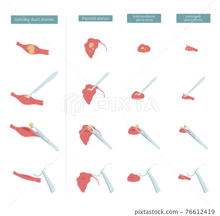 Vector flat illustration of surgery to remove stones from the parotid, submandibular and sublingual salivary glands. Vector flat illustration of surgery to remove stones from the parotid, submandibular and sublingual salivary glands. 76612419