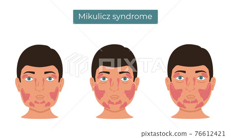 Vector illustration of Mikulicz syndrome. Enlargement of the lacrimal and salivary glands. Vector illustration of Mikulicz syndrome. Enlargement of the lacrimal and salivary glands. 76612421
