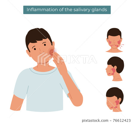 Vector flat illustration of a person with inflamed salivary glands. The guy feels pain in the salivary gland. 76612423