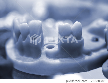 Collapsible jaw model with teeth and holes for the implant crown abutment Collapsible jaw model with teeth and holes for the implant crown abutment 76680388