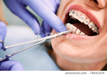 Doctor hands placing braces on woman teeth. Doctor hands placing braces on woman teeth. 76681834