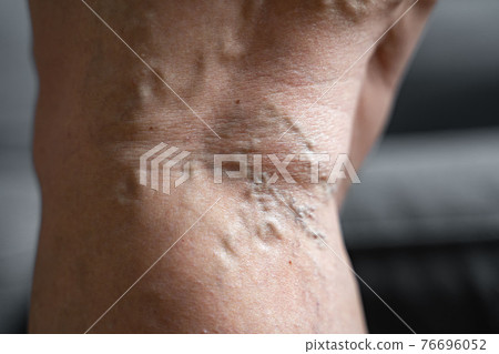 Varicose vein close up leg. Senior woman health problem. Foot with Diseased Veins. Health Care 76696052