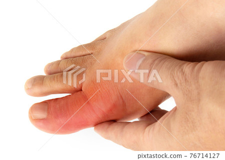 Big toe with gout 76714127