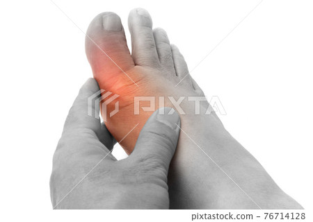 痛風腳趾 痛風腳趾 76714128