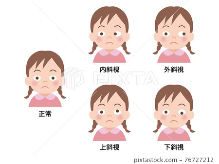 Illustration of a squint girl 76727212