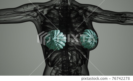 medical scan of Woman Breast Cancer 76742278