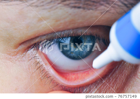 Instill eyedrops or ointment on eye. Instill eyedrops or ointment on eye. 76757149