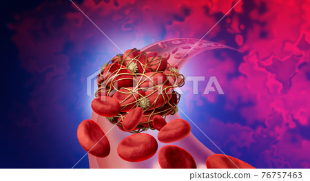 Blood Clot Risk 76757463