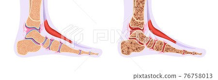 Anatomy of a healthy ankle and ankle disease 76758013