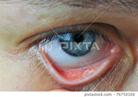 Instill eyedrops or ointment on eye. 76758108