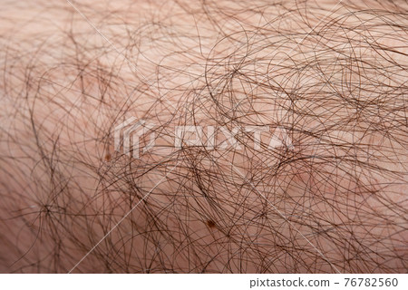 Men's hair removal before image Leg up Men's hair removal before image Leg up 76782560