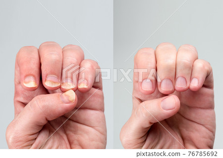Before and after successful treatment for a onychomycosis or fungal nail infection on damaged nails after gel polish, onychosis. Longitudinal ridging nails with psoriasis, nail diseases. 76785692