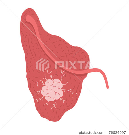 A tumor on the parotid salivary gland. Medical vector illustration. 76824997