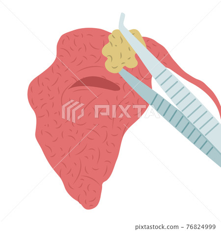Vector illustration of removing a stone from the parotid salivary gland. Sialolithiasis Vector illustration of removing a stone from the parotid salivary gland. Sialolithiasis 76824999