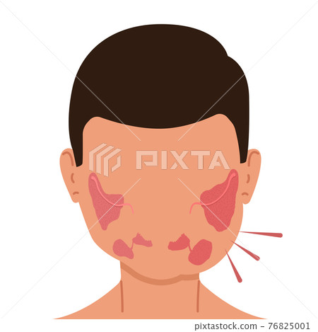 A person with inflamed salivary glands. Medical vector illustration. A person with inflamed salivary glands. Medical vector illustration. 76825001