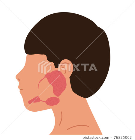 Person and salivary glands, parotid, submandibular and sublingual glands. Medical vector illustration. Person and salivary glands, parotid, submandibular and sublingual glands. Medical vector illustration. 76825002