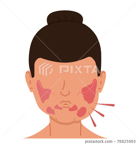 Woman with inflamed salivary glands. Medical vector illustration. Woman with inflamed salivary glands. Medical vector illustration. 76825003