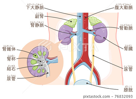Illustration of kidney, ureter, bladder, kidney stone (with text) 76832093