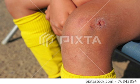 The leg of a child whose knee was injured in a youth soccer match 76842854