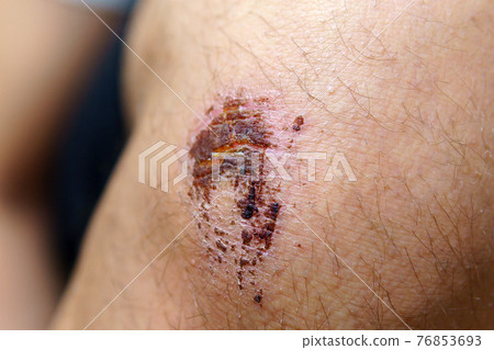 skin of the knee caused by an accident. Close-up of knee bruised wounded. selective focus skin of the knee caused by an accident. Close-up of knee bruised wounded. selective focus 76853693