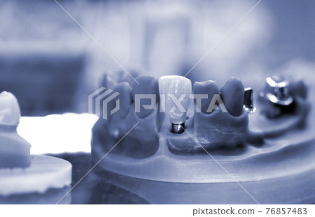 Collapsible jaw model with teeth and holes for the implant crown abutment 76857483