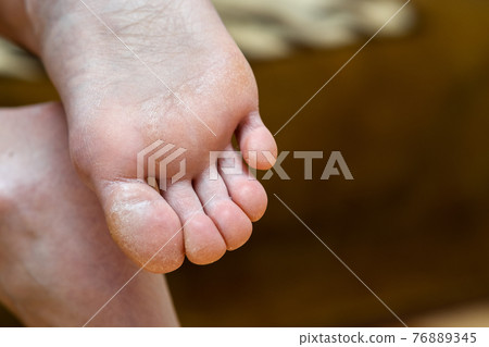 Closeup of woman feet sole with dry cracked skin. Foot and toes care concept. Closeup of woman feet sole with dry cracked skin. Foot and toes care concept. 76889345