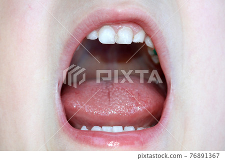 boy openning his moth boy openning his moth 76891367