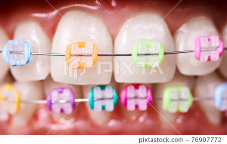 Orthodontic brackets with rubber bands on patient teeth. Orthodontic brackets with rubber bands on patient teeth. 76907772
