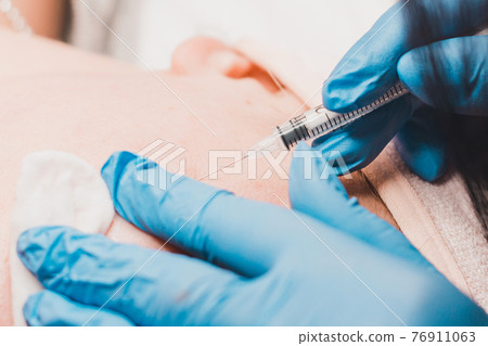 Miliums on the face, removal of hardened and mature milia by a beautician. 76911063