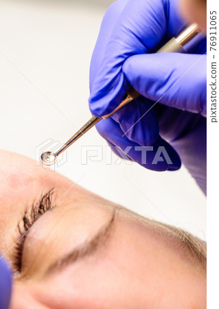 Milium on the face, removal of milia with a syringe in cosmetology. 76911065