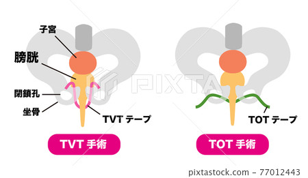 用於 TVT 手術和 TOT 手術的尿失禁醫學插圖材料 用於 TVT 手術和 TOT 手術的尿失禁醫學插圖材料 77012443