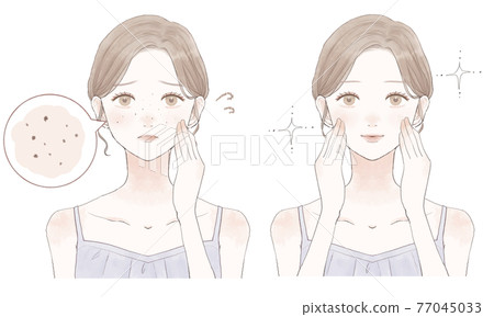 Before and after women suffering from darkened pores 77045033