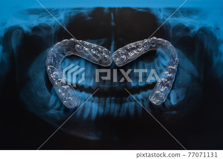 Transparent bite correction trays and x-ray of the jaw. Orthodontist equipment 77071131
