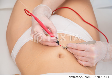 Woman on electro epilation on her tummy. Permanent hardware removal of unwanted abdominal hair. Woman on electro epilation on her tummy. Permanent hardware removal of unwanted abdominal hair. 77071411