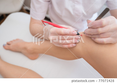 Close-up of electro epilation on the leg. The doctor removes unwanted hair from the patient with an electric device and tweezers 77071428