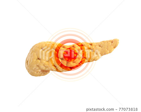 Disease or pain concept of human pancreas isolated on white. 3d illustration  77073818