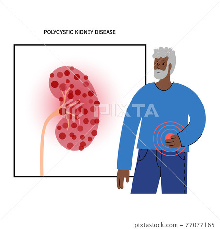Kidney disease concept 77077165