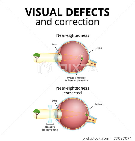structure of the eyeball, visual impairment, near-sightedness structure of the eyeball, visual impairment, near-sightedness 77087074