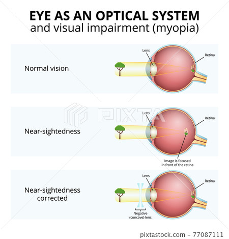 structure of the eyeball, visual impairment, near-sightedness structure of the eyeball, visual impairment, near-sightedness 77087111