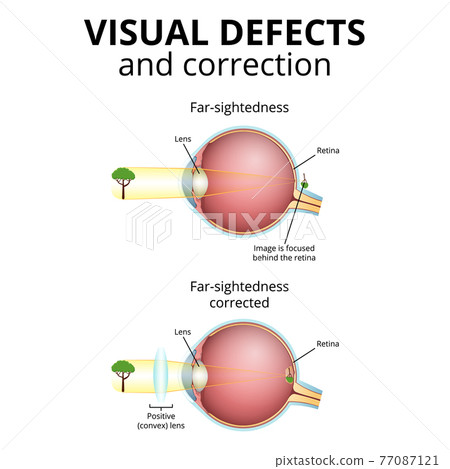 structure of the eyeball, visual impairment, farsightedness 77087121