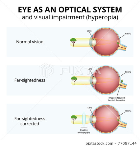 structure of the eyeball, visual impairment, farsightedness structure of the eyeball, visual impairment, farsightedness 77087144