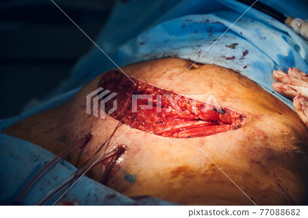 Doctor hands doing abdominoplasty surgery in operating room. 77088682