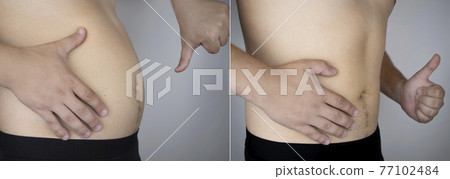 The man shows the results of work on the body. Before and after a thick and thin waist. In the photo on the left, belly fat is visible. In the photo on the right, a thin waist without extra kilograms 77102484
