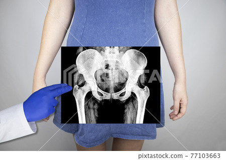 X-ray of the pelvic bones of a woman. Radiologist examines X-ray examination. A picture of the hip joint is superimposed on the patient body. 77103663