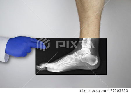 X-ray of a man foot. A photograph of the leg bones is applied to the patient feet. The radiologist examines the X-ray. X-ray of a man foot. A photograph of the leg bones is applied to the patient feet. The radiologist examines the X-ray. 77103750