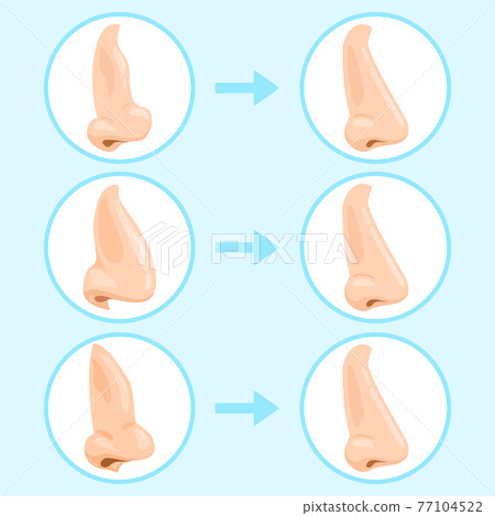 Cartoon rhinoplasty surgery. Rhinoplasty before and after, nose plastic surgery result. Rhinoplasty surgery infographic vector illustration set Cartoon rhinoplasty surgery. Rhinoplasty before and after, nose plastic surgery result. Rhinoplasty surgery infographic vector illustration set 77104522