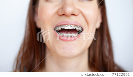 The woman smiles, showing her white and even teeth with braces. The woman smiles, showing her white and even teeth with braces. 77122961