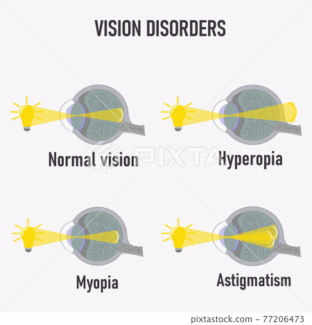 Common Visual Impairments. Astigmatism, Myopia... - Stock Illustration ...